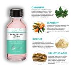 Alternate image 1 for Clixit 1 oz.  Acne Drying Lotion