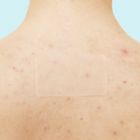 Alternate image 3 for Rael Beauty Miracle Patch XL Spot Control Cover