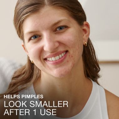 Neutrogena&reg; 10-Count Stubborn Acne Blemish Patches. View a larger version of this product image.