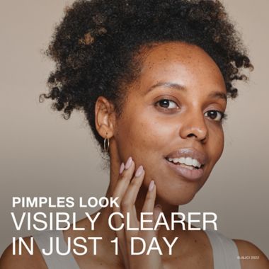 Neutrogena&reg; 1 fl. oz. Stubborn Acne Drying Lotion. View a larger version of this product image.